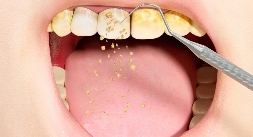 Imagem de uma boca aberta com dentes amarelados sendo limpos por um instrumento dental, com fragmentos de placa sendo removidos, ideal para sites de odontologia, saúde bucal ou clínicas dentárias.